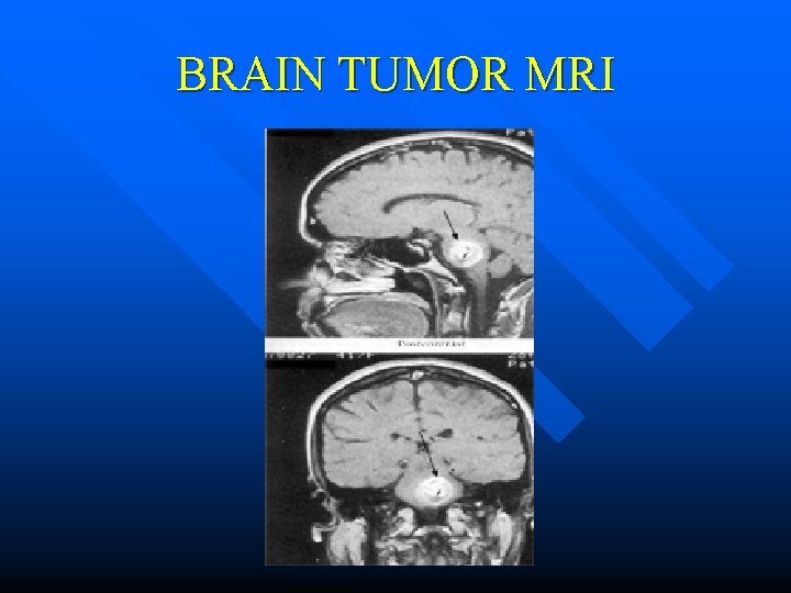 BRAIN TUMOR MRI 