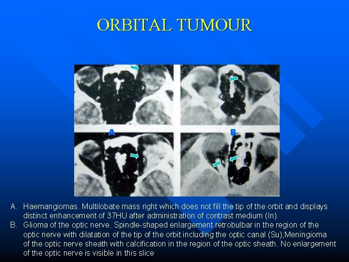 ORBITAL TUMOUR A B A. Haemangiomas. Multilobate mass right which does not fill the