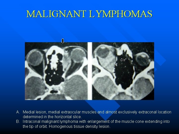 MALIGNANT LYMPHOMAS A. Medial lesion, medial extraocular muscles and almost exclusively extraconal location determined