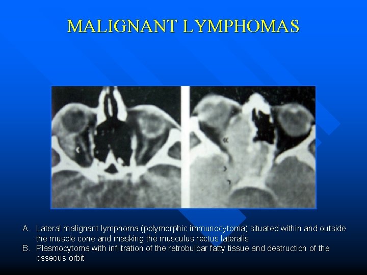 MALIGNANT LYMPHOMAS A. Lateral malignant lymphoma (polymorphic immunocytoma) situated within and outside the muscle