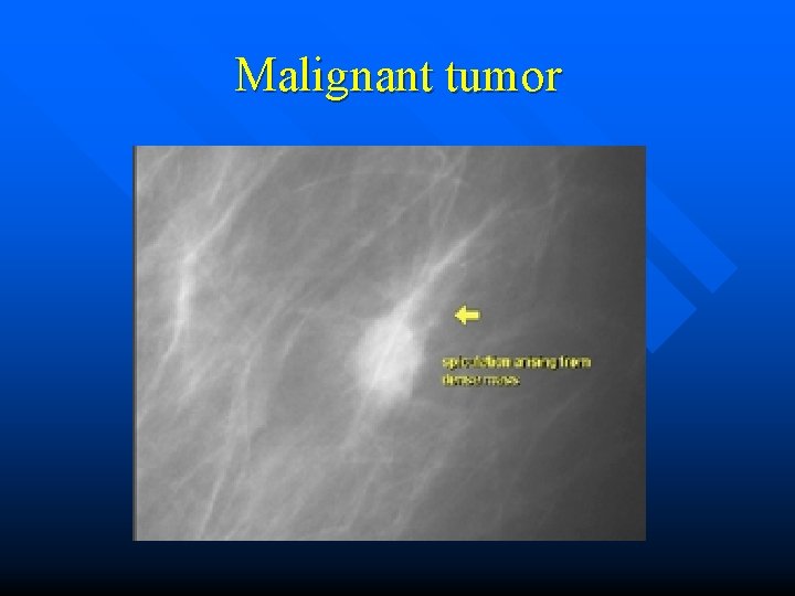 Malignant tumor 