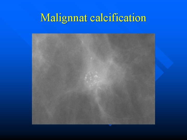 Malignnat calcification 