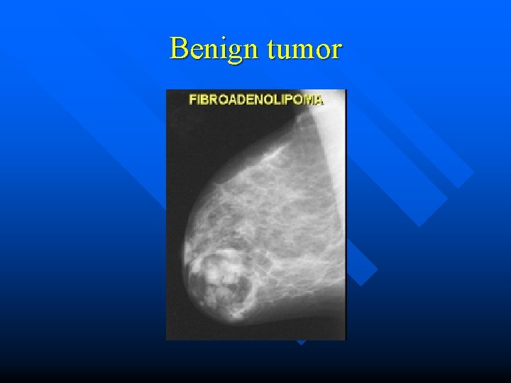 Benign tumor 