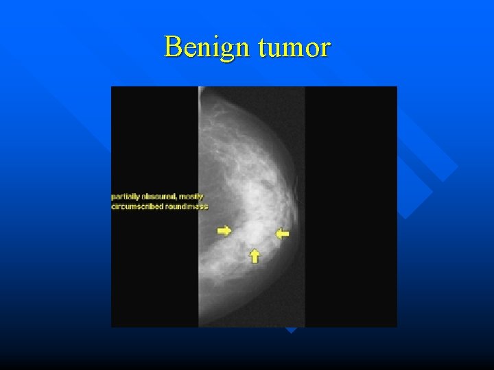 Benign tumor 