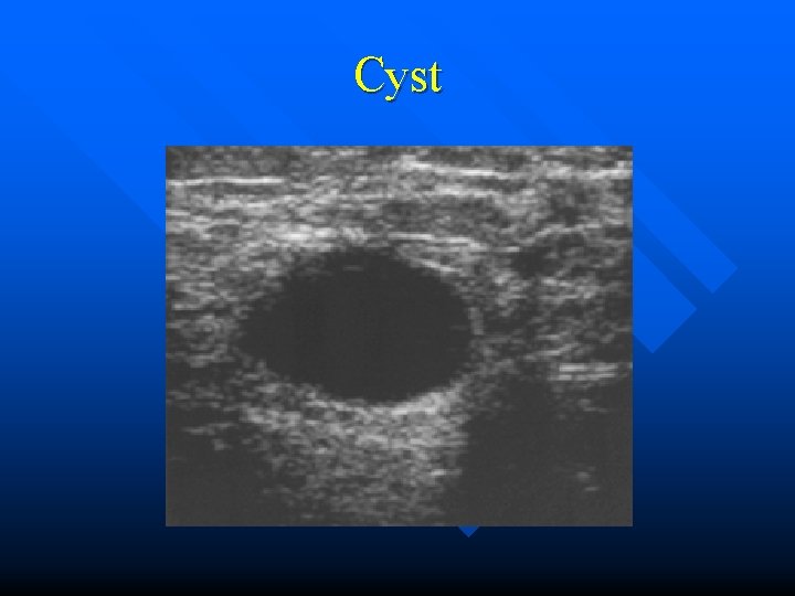 Cyst 