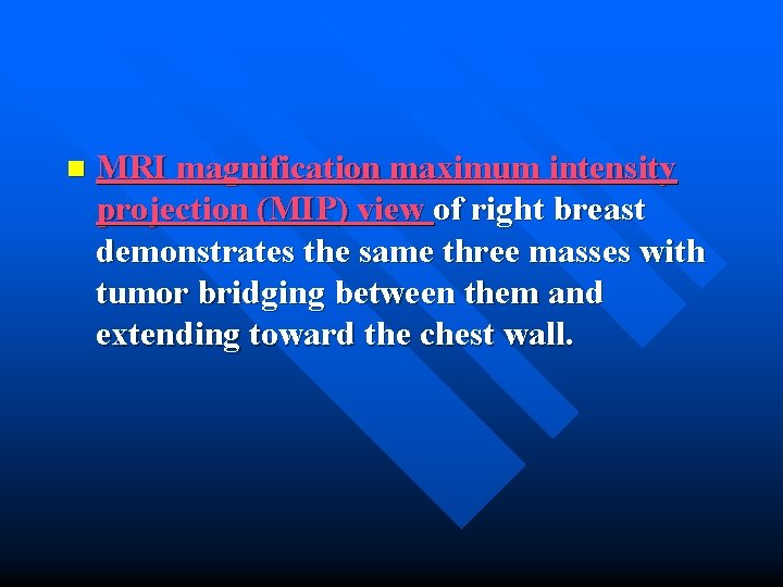 n MRI magnification maximum intensity projection (MIP) view of right breast demonstrates the same