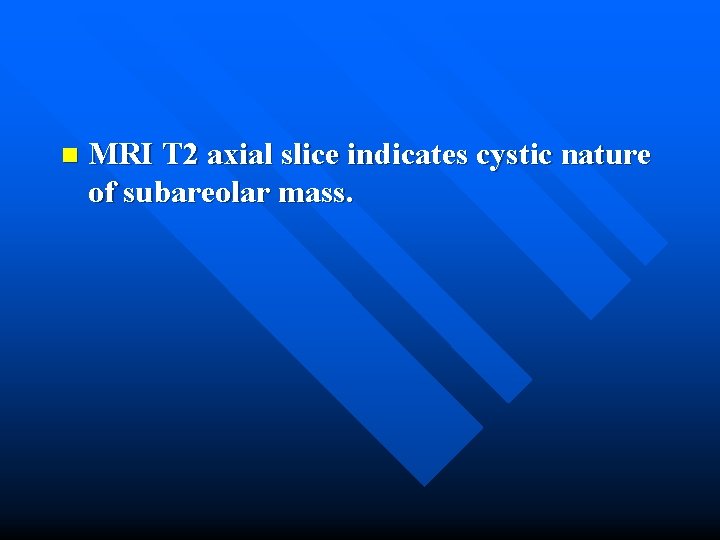 n MRI T 2 axial slice indicates cystic nature of subareolar mass. 