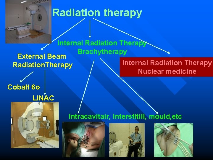 Radiation therapy Internal Radiation Therapy Brachytherapy External Beam Internal Radiation Therapy Radiation. Therapy Nuclear