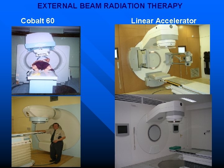 EXTERNAL BEAM RADIATION THERAPY Cobalt 60 Linear Accelerator 