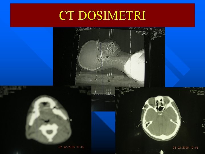 CT DOSIMETRI 