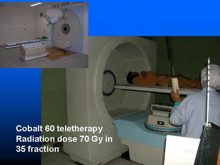 Cobalt 60 teletherapy Radiation dose 70 Gy in 35 fraction 