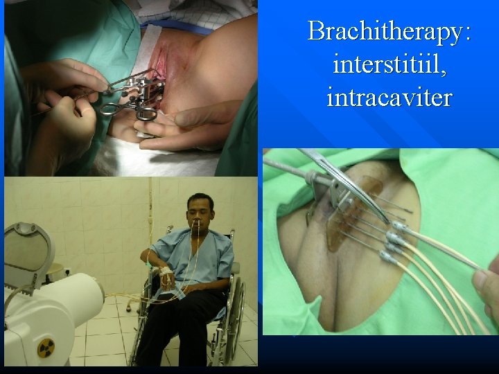 Brachitherapy: interstitiil, intracaviter 