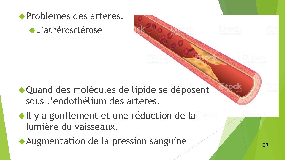  Problèmes des artères. L’athérosclérose Quand des molécules de lipide se déposent sous l’endothélium