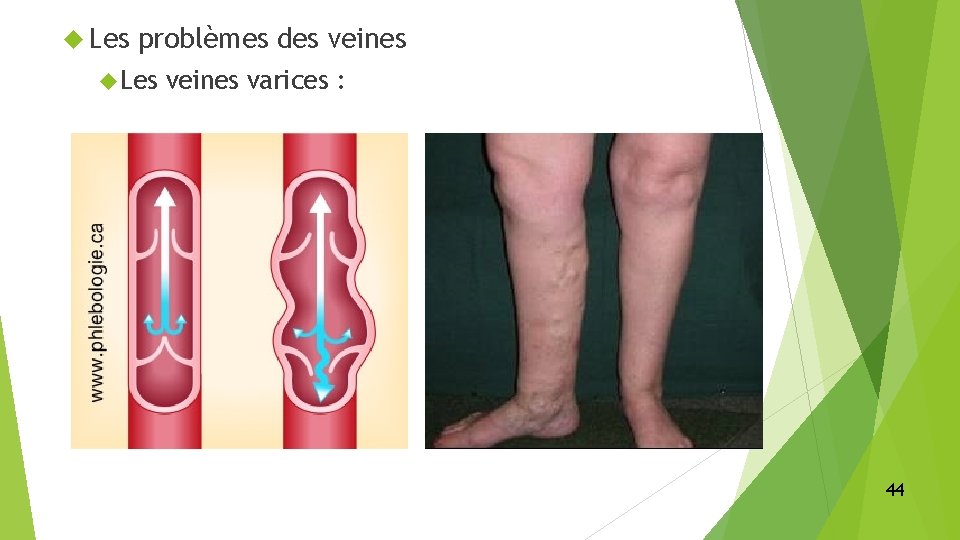  Les problèmes des veines Les veines varices : 44 