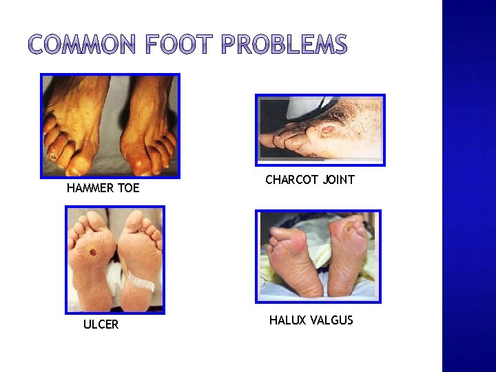 HAMMER TOE ULCER CHARCOT JOINT HALUX VALGUS 