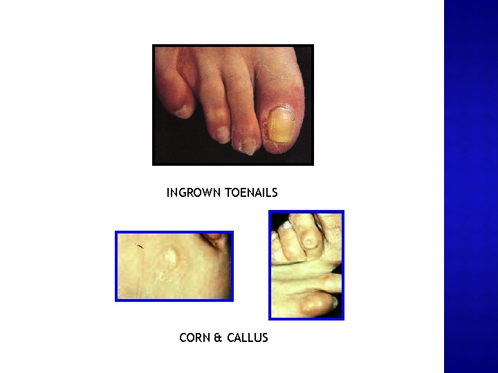 INGROWN TOENAILS CORN & CALLUS 
