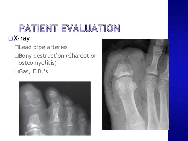 � X-ray �Lead pipe arteries �Bony destruction (Charcot or osteomyelitis) �Gas, F. B. ’s