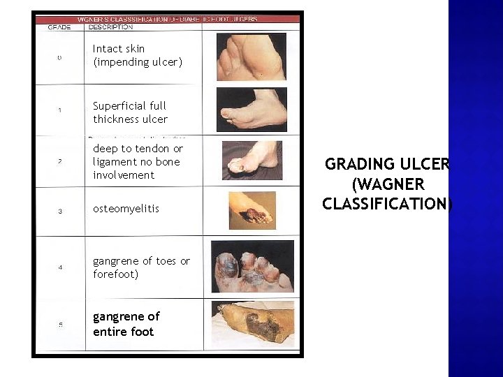 Intact skin (impending ulcer) Superficial full thickness ulcer deep to tendon or ligament no