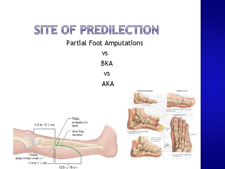 Partial Foot Amputations vs BKA vs AKA 