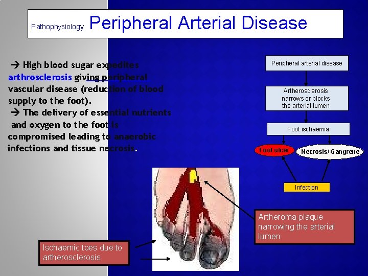 Pathophysiology Peripheral Arterial Disease High blood sugar expedites arthrosclerosis giving peripheral vascular disease (reduction