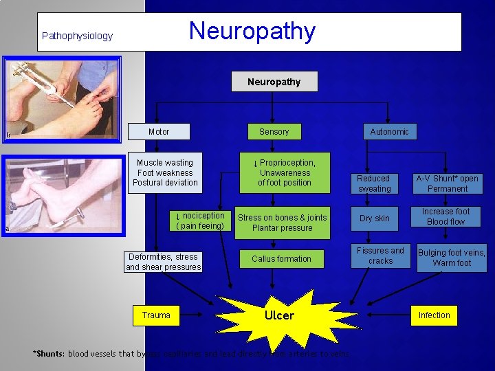 Neuropathy Pathophysiology Neuropathy Motor Sensory Muscle wasting Foot weakness Postural deviation ↓ nociception (