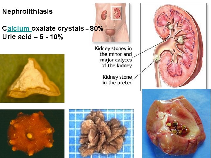 Nephrolithiasis Calcium oxalate crystals – 80% Uric acid – 5 - 10% 