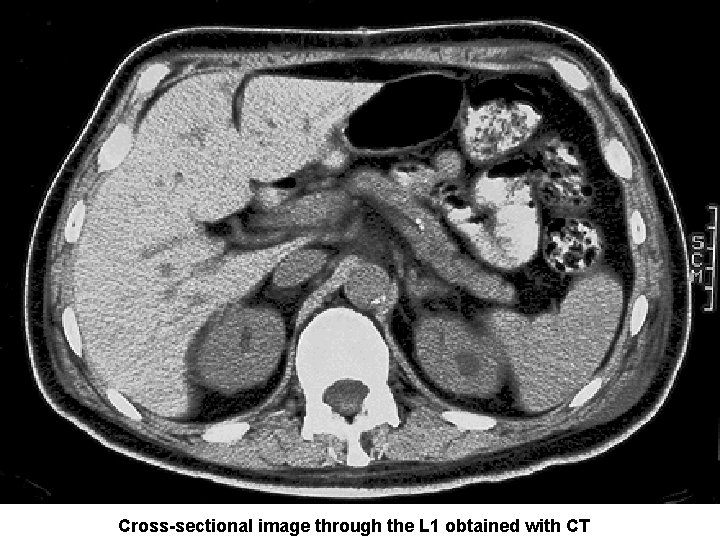 Cross-sectional image through the L 1 obtained with CT 