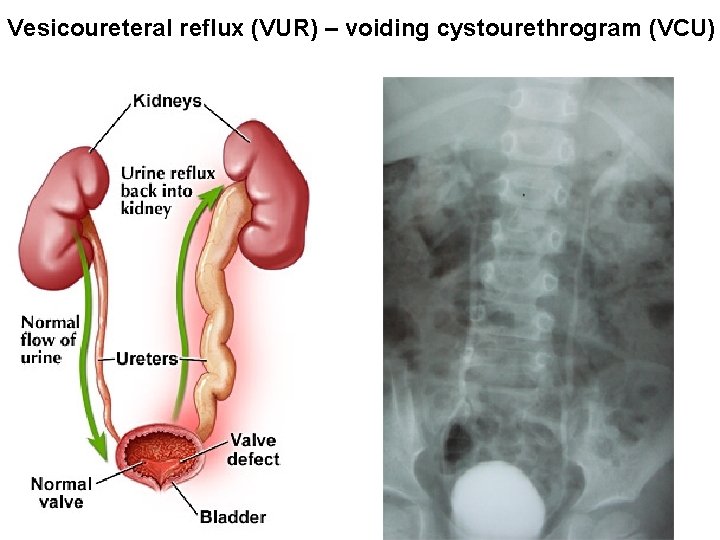 Vesicoureteral reflux (VUR) – voiding cystourethrogram (VCU) 