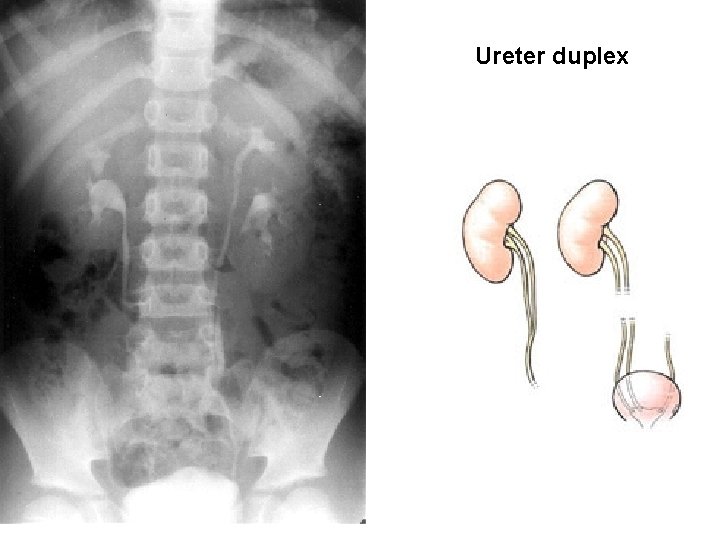 Ureter duplex 