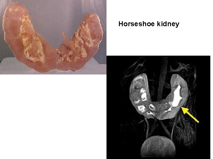 Horseshoe kidney 
