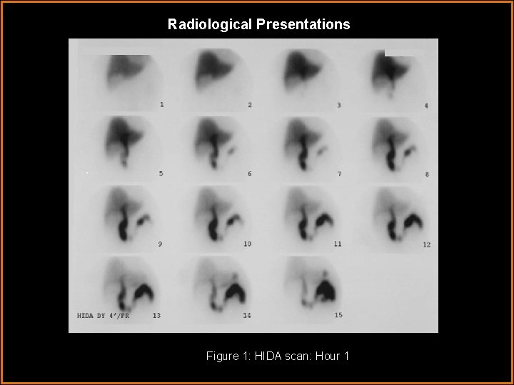 Radiological Presentations Figure 1: HIDA scan: Hour 1 