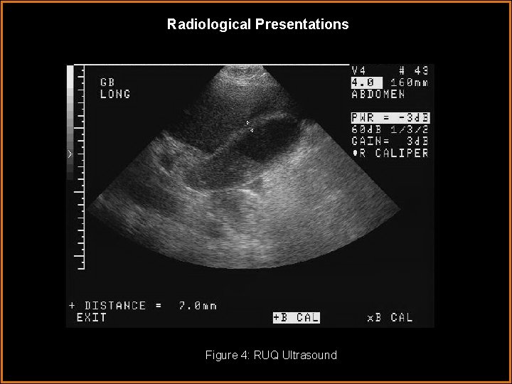 Radiological Presentations Figure 4: RUQ Ultrasound 