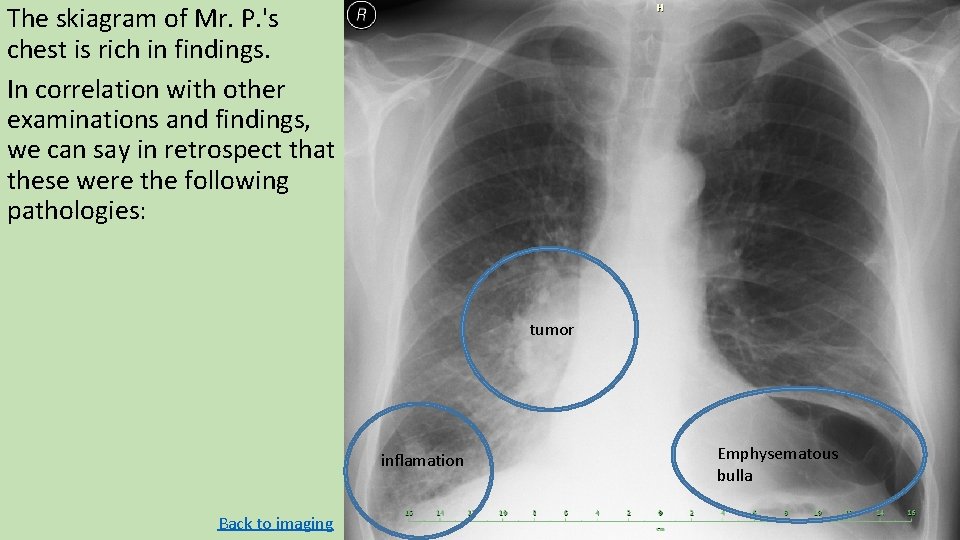 The skiagram of Mr. P. 's chest is rich in findings. In correlation with The skiagram of Mr. P. 's chest is rich in findings. In correlation with