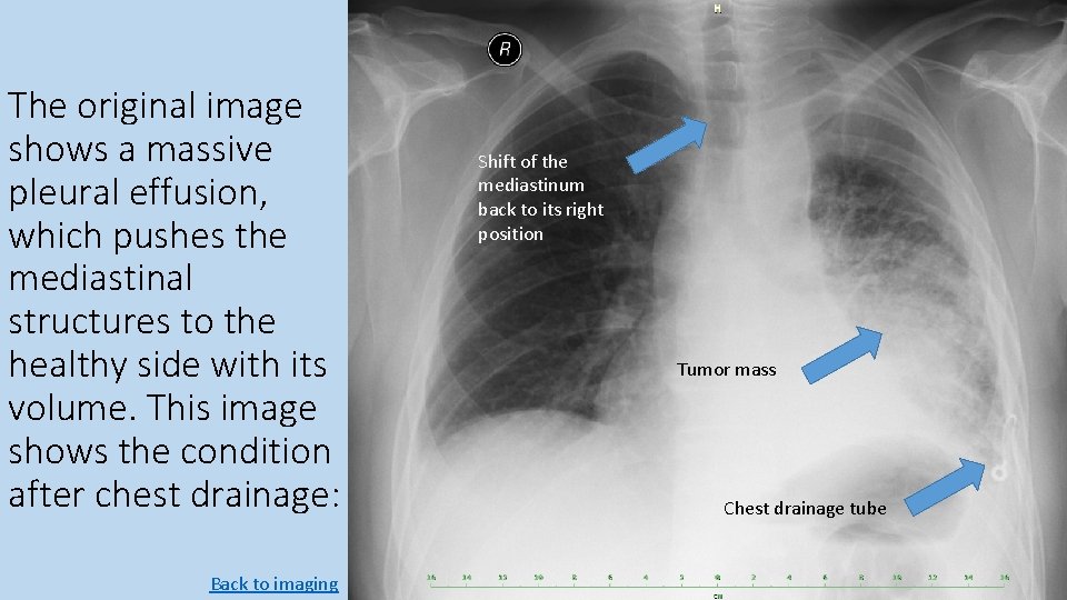The original image shows a massive pleural effusion, which pushes the mediastinal structures to The original image shows a massive pleural effusion, which pushes the mediastinal structures to