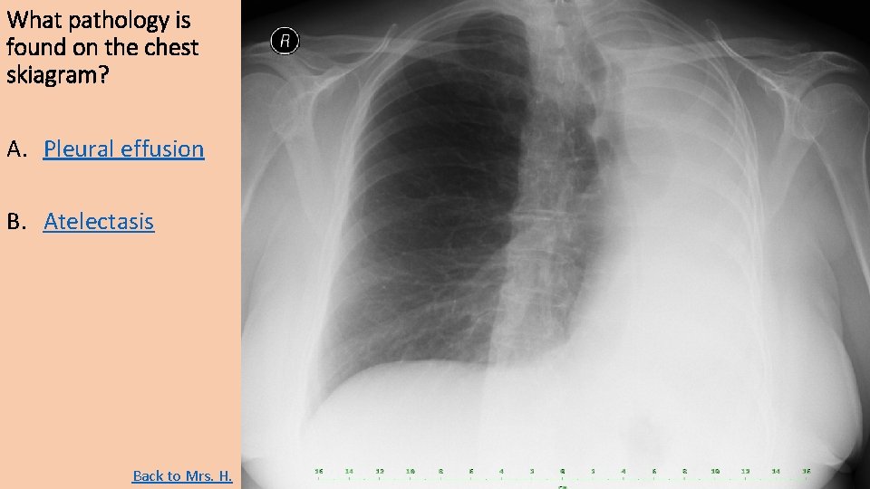 What pathology is found on the chest skiagram? A. Pleural effusion B. Atelectasis Back What pathology is found on the chest skiagram? A. Pleural effusion B. Atelectasis Back
