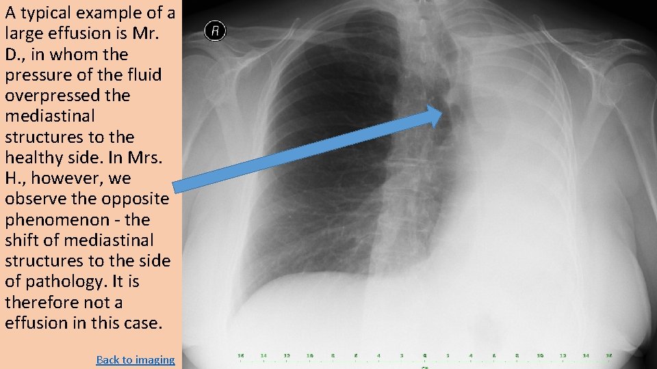 A typical example of a large effusion is Mr. D. , in whom the A typical example of a large effusion is Mr. D. , in whom the