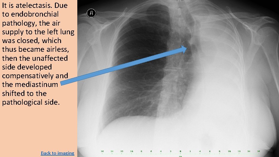 It is atelectasis. Due to endobronchial pathology, the air supply to the left lung It is atelectasis. Due to endobronchial pathology, the air supply to the left lung