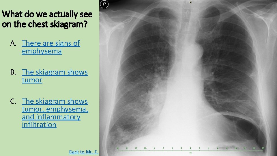 What do we actually see on the chest skiagram? A. There are signs of What do we actually see on the chest skiagram? A. There are signs of