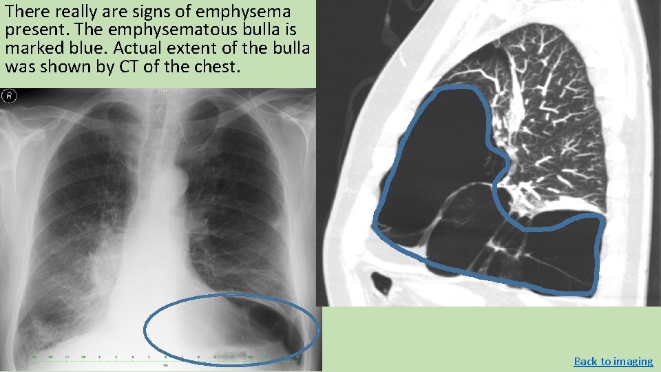There really are signs of emphysema present. The emphysematous bulla is marked blue. Actual There really are signs of emphysema present. The emphysematous bulla is marked blue. Actual