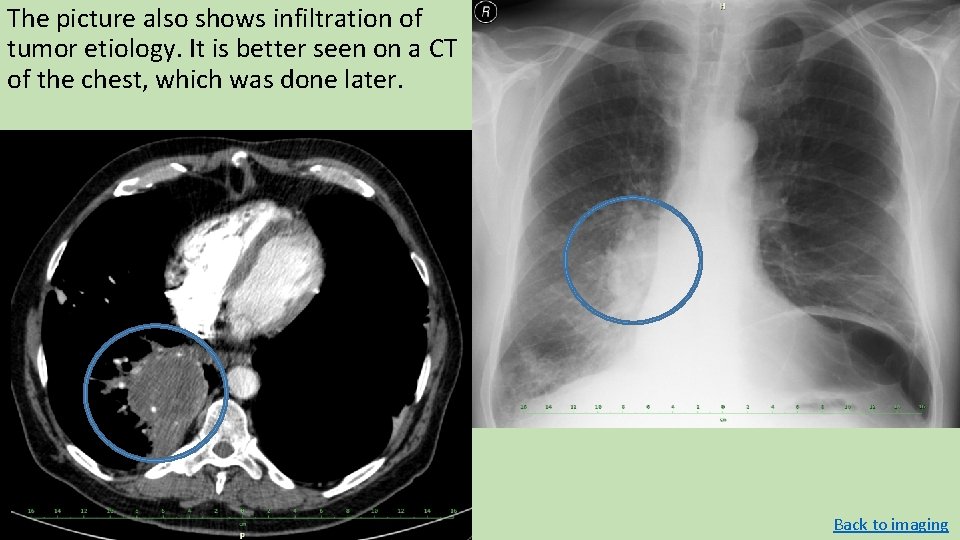 The picture also shows infiltration of tumor etiology. It is better seen on a The picture also shows infiltration of tumor etiology. It is better seen on a