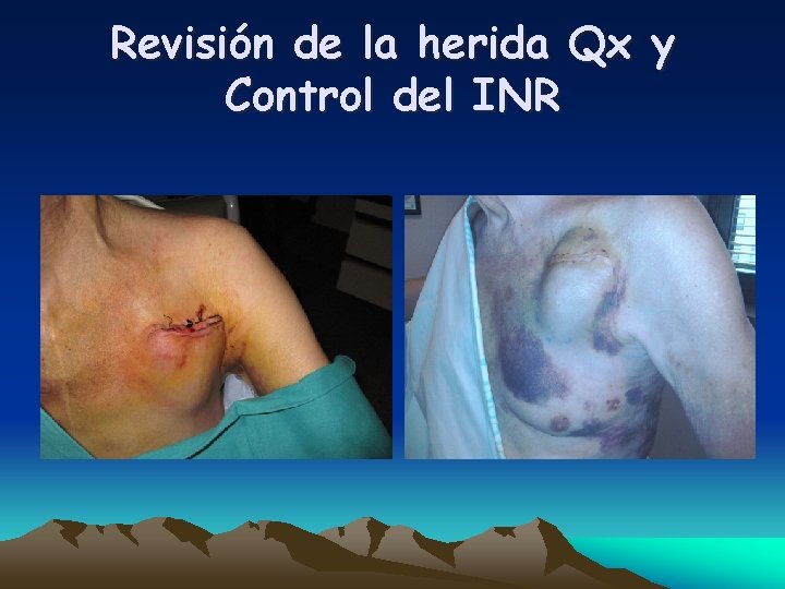 Revisión de la herida Qx y Control del INR 