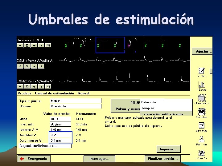 Umbrales de estimulación 