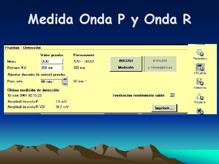 Medida Onda P y Onda R 