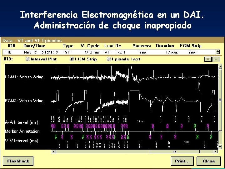 Interferencia Electromagnética en un DAI. Administración de choque inapropiado 