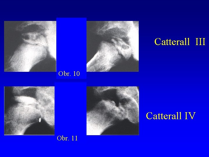 Catterall III Obr. 10 Catterall IV Obr. 11 