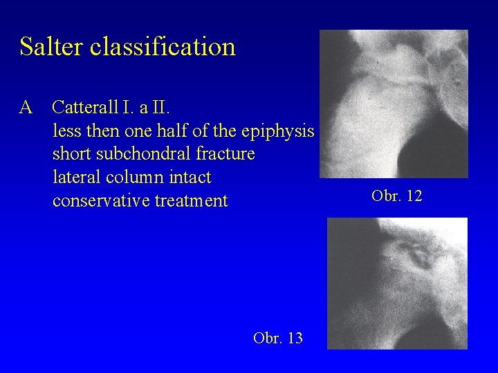 Salter classification A Catterall I. a II. less then one half of the epiphysis
