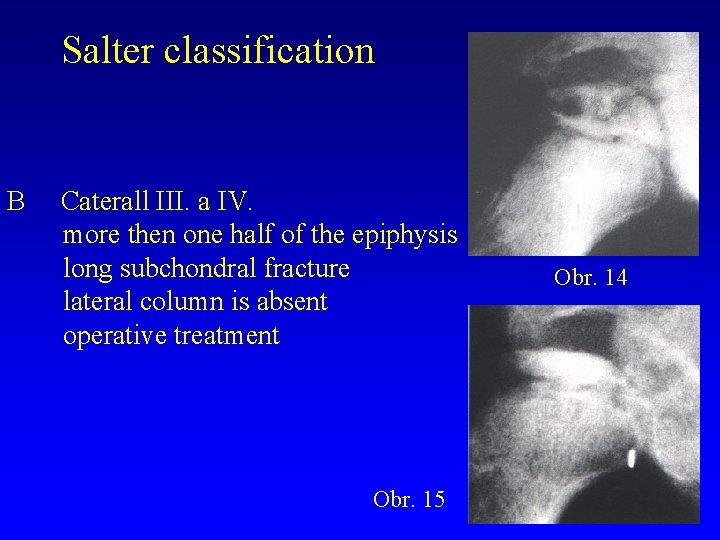 Salter classification B Caterall III. a IV. more then one half of the epiphysis