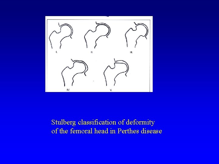 Stulberg classification of deformity of the femoral head in Perthes disease 