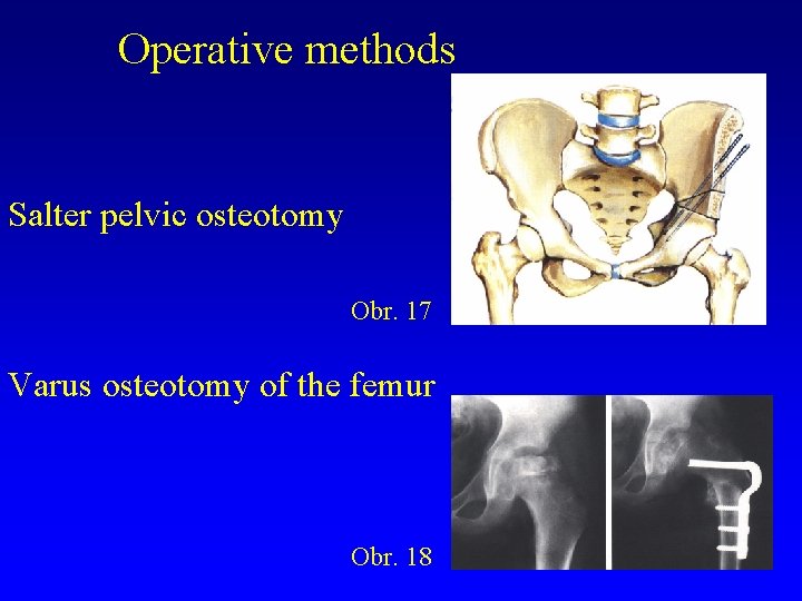 Operative methods Salter pelvic osteotomy Obr. 17 Varus osteotomy of the femur Obr. 18