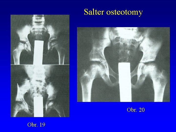 Salter osteotomy Obr. 20 Obr. 19 